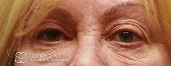 Blepharoplasty Case 03 Before