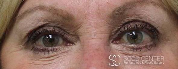 Blepharoplasty Case 03 After