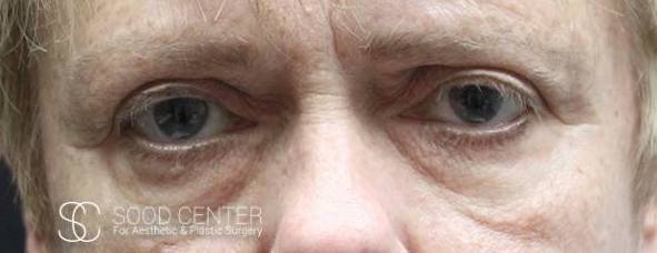 Blepharoplasty Case 04 Before