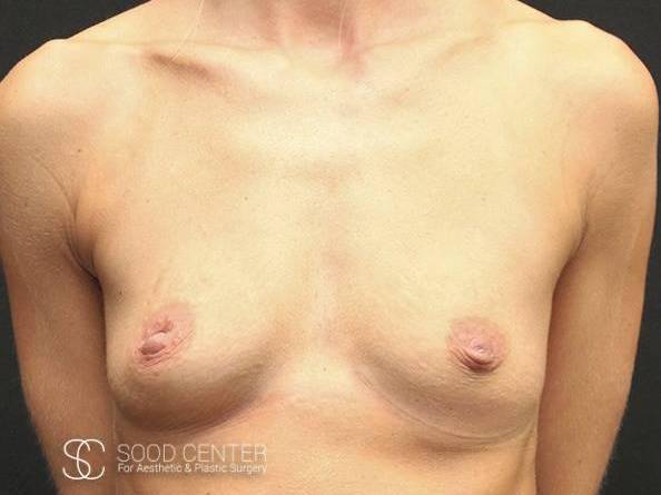 Breast Augmentation Case 09 Before