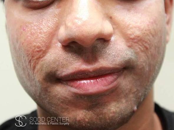 Microneedling Before and After Pictures Before