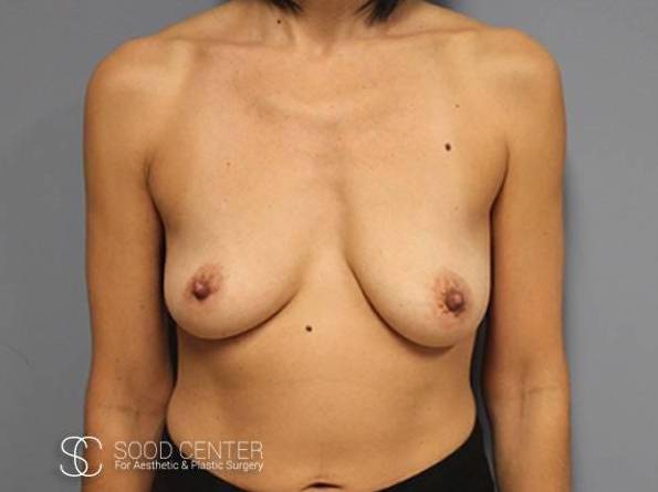 Breast Augmentation Case 10 Before