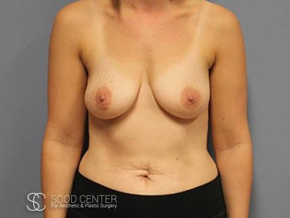 Breast Augmentation Case 11 Before