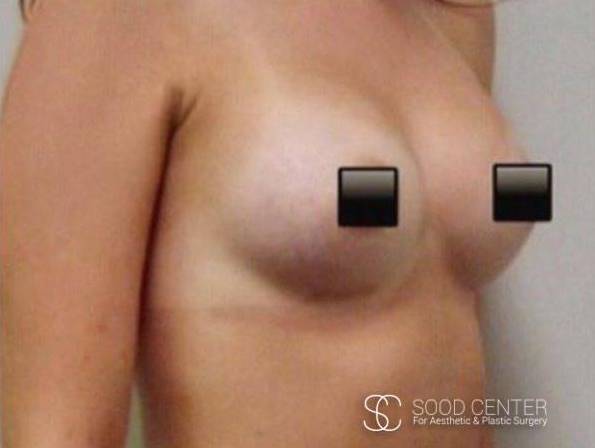 Breast Augmentation Case 12 After