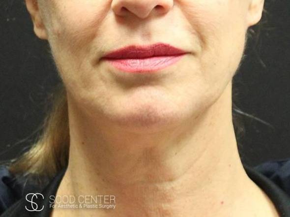 Necklift Before & After Pictures Before