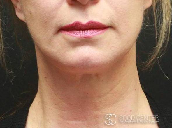 Necklift Before & After Pictures After