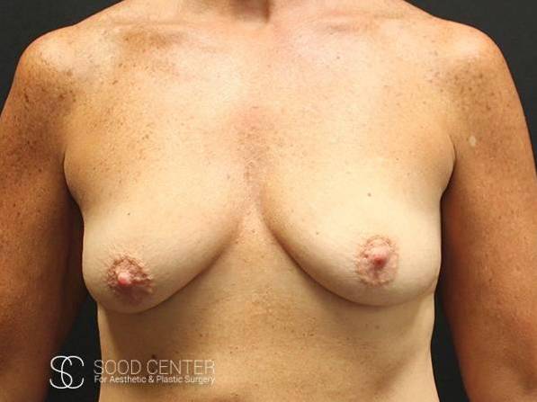 Breast Augmentation with Lift Before and After Pictures Before