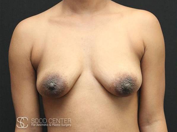Breast Augmentation with Lift Case 03 Before