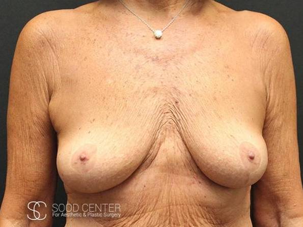 Breast Augmentation with Lift Case 04 Before