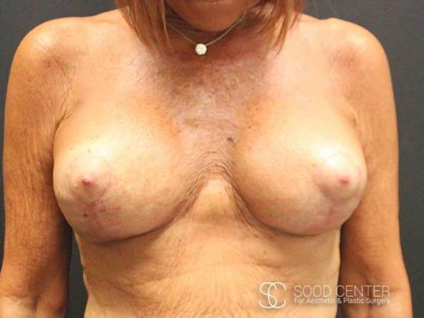 Breast Augmentation with Lift Case 04 After