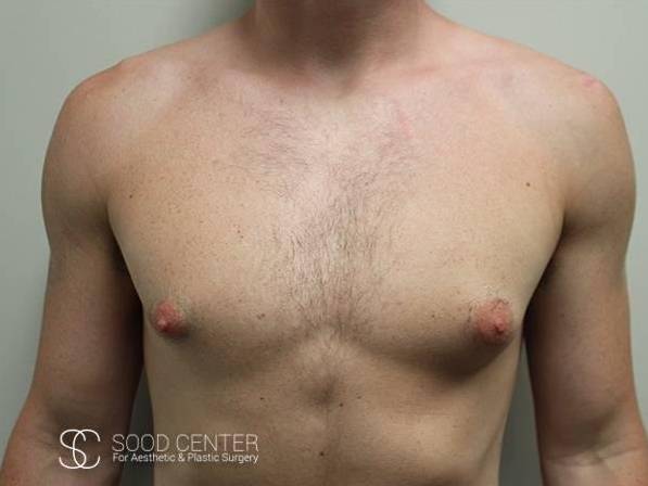 Gynecomastia Before and After Pictures Before