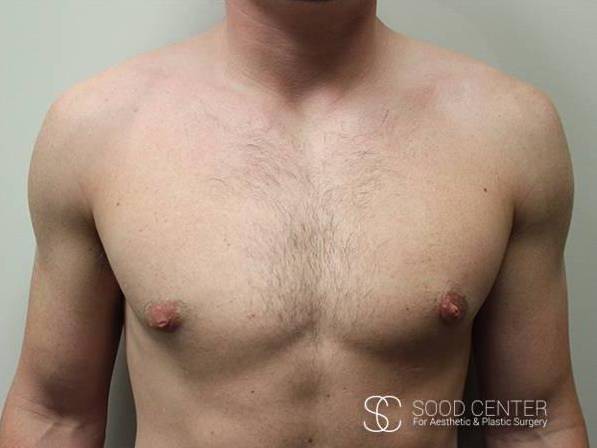 Gynecomastia Before and After Pictures After