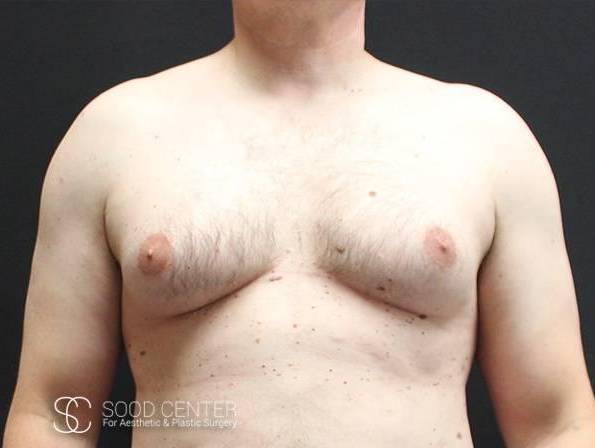 Gynecomastia Case 02 Before