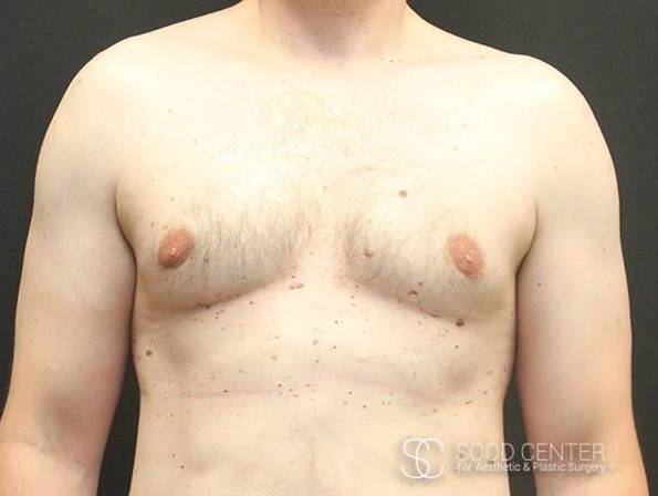 Gynecomastia Case 02 After