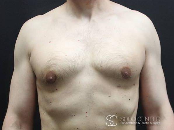 Gynecomastia Case 03 After