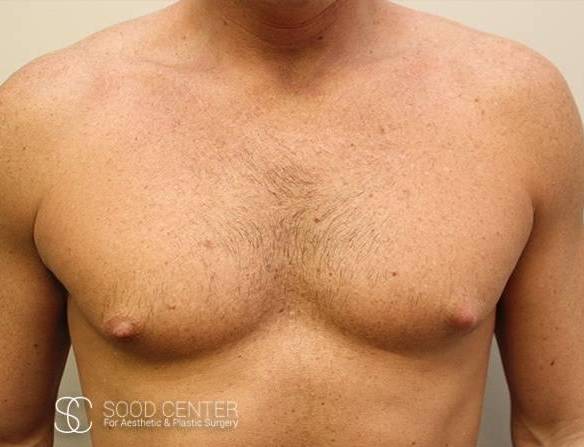 Gynecomastia Case 04 Before