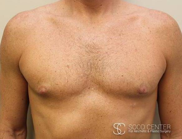 Gynecomastia Case 04 After