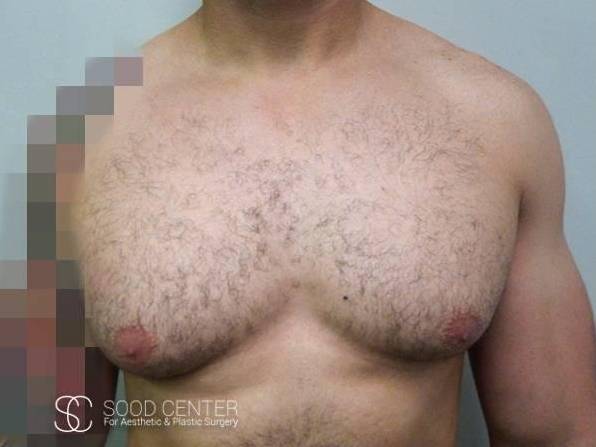 Gynecomastia Case 05 Before