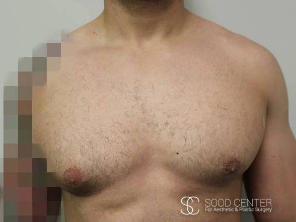 Gynecomastia Case 05 After