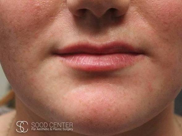 Lip Augmentation Before and After Pictures Before