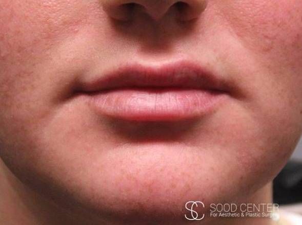 Lip Augmentation Before and After Pictures After
