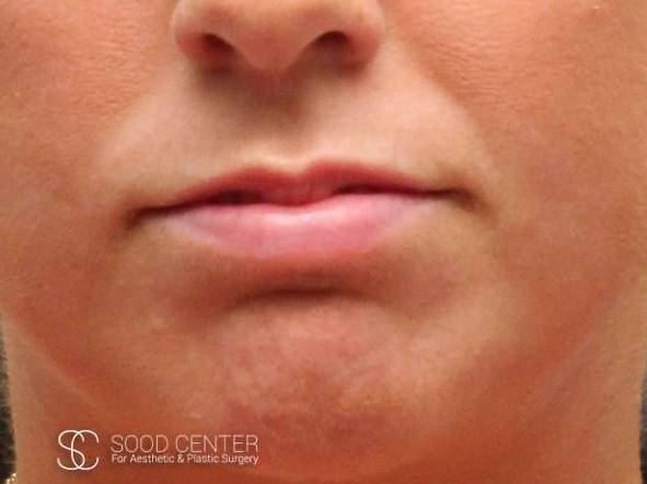 Lip Augmentation Case 02 Before