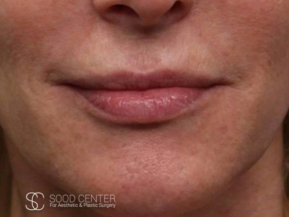 Lip Augmentation Case 03 Before