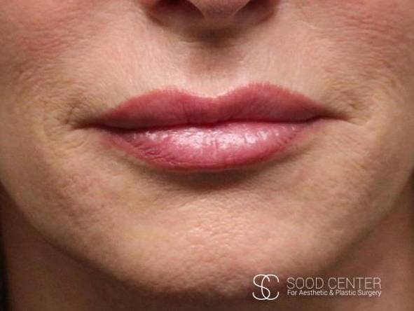 Lip Augmentation Case 03 After