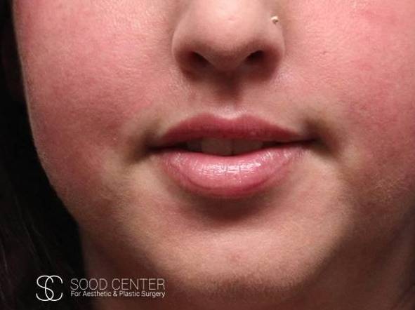 Lip Augmentation Case 04 Before