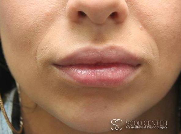 Lip Augmentation Case 06 After