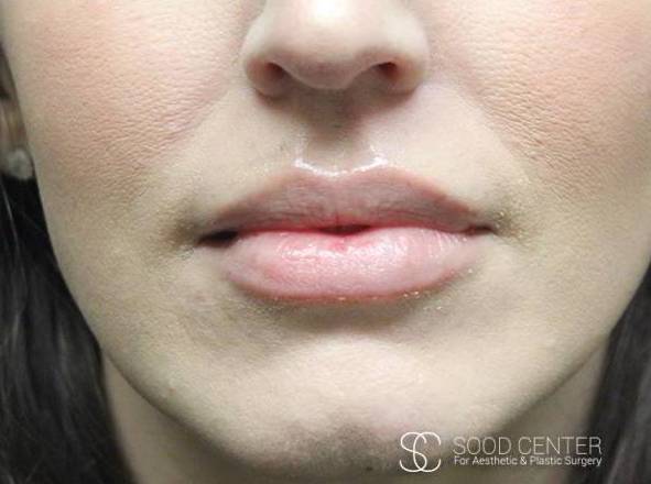 Lip Augmentation Case 07 After