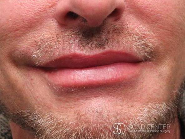 Lip Augmentation Case 09 After