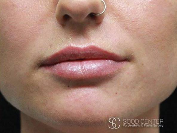 Lip Augmentation Case 10 After