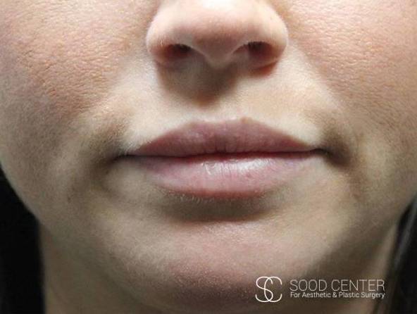 Lip Augmentation Case 11 After