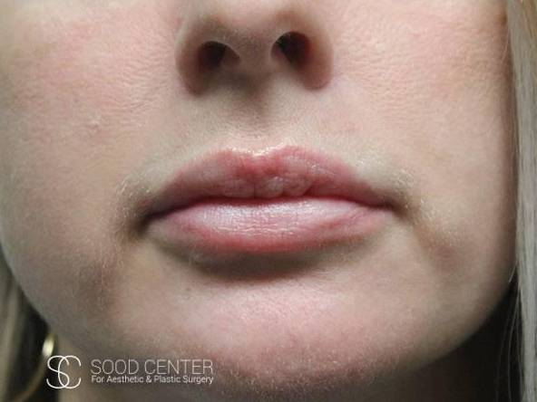 Lip Augmentation Case 12 Before