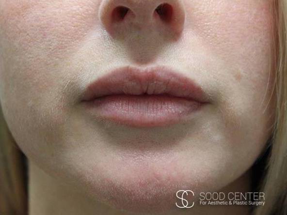 Lip Augmentation Case 12 After