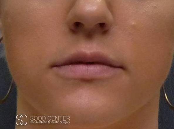 Lip Augmentation Case 13 Before