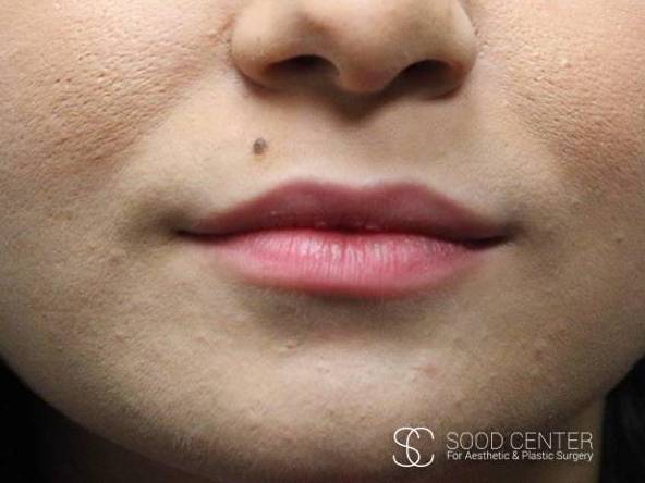 Lip Augmentation Case 14 After