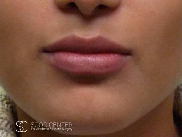 Lip Augmentation Case 15 Before