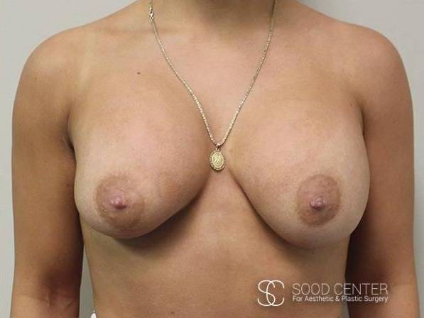 Breast Revision Before and After Picture After