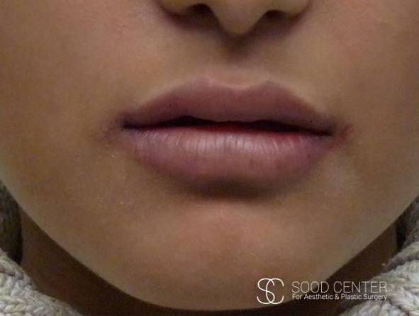 Lip Augmentation Case 15 After