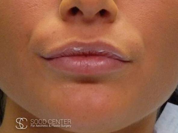 Lip Augmentation Case 16 Before