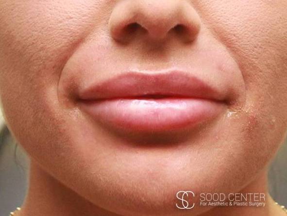 Lip Augmentation Case 16 After