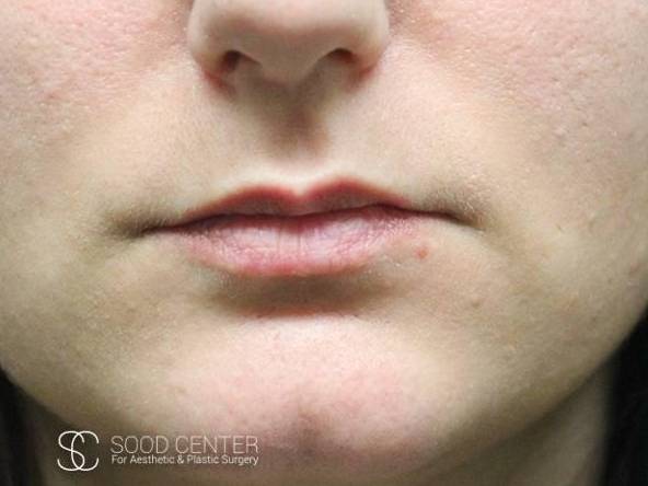 Lip Augmentation Case 17 Before