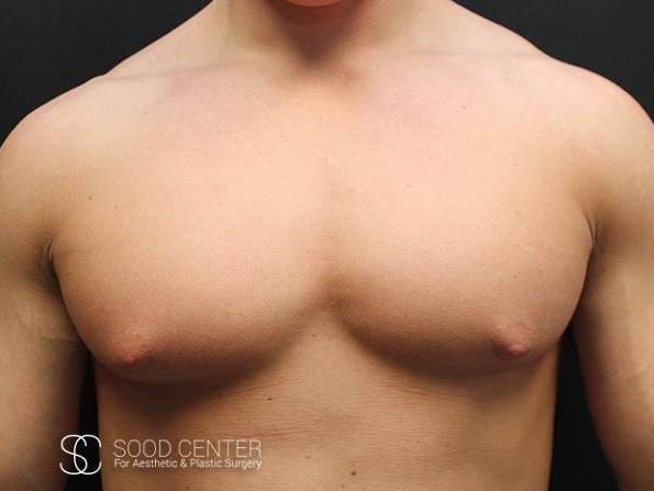 Gynecomastia Case 06 Before