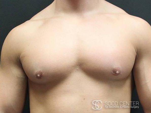 Gynecomastia Case 06 After