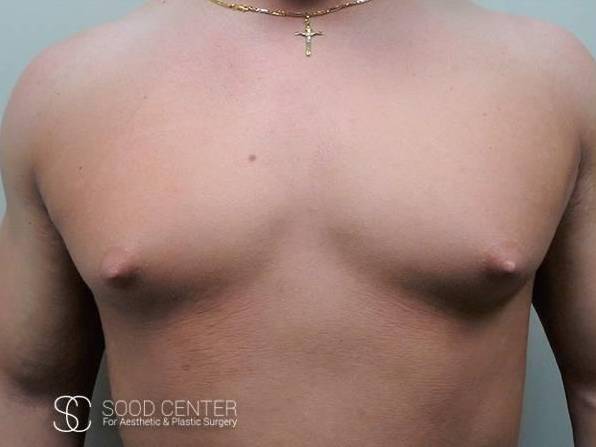 Gynecomastia Case 07 Before