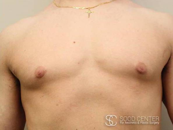 Gynecomastia Case 07 After