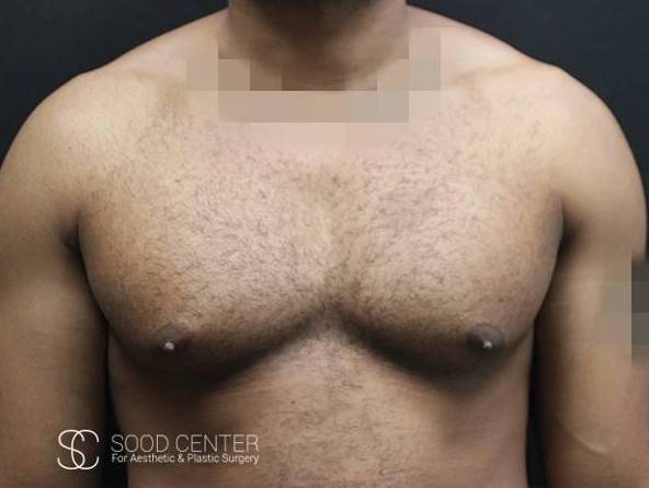 Gynecomastia Case 08 Before