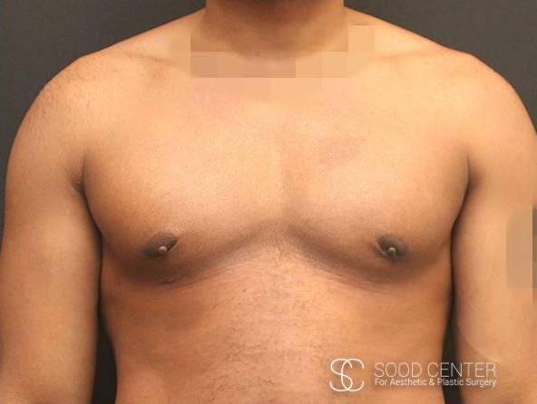 Gynecomastia Case 08 After